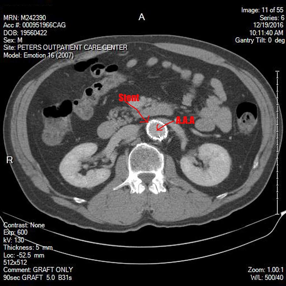 abdominal, aortic, aneurysm, science, biology, cardiovascular HD wallpaper