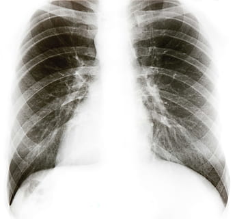 x, ray, chest, xray, health, care, medical, x-ray, background HD wallpaper