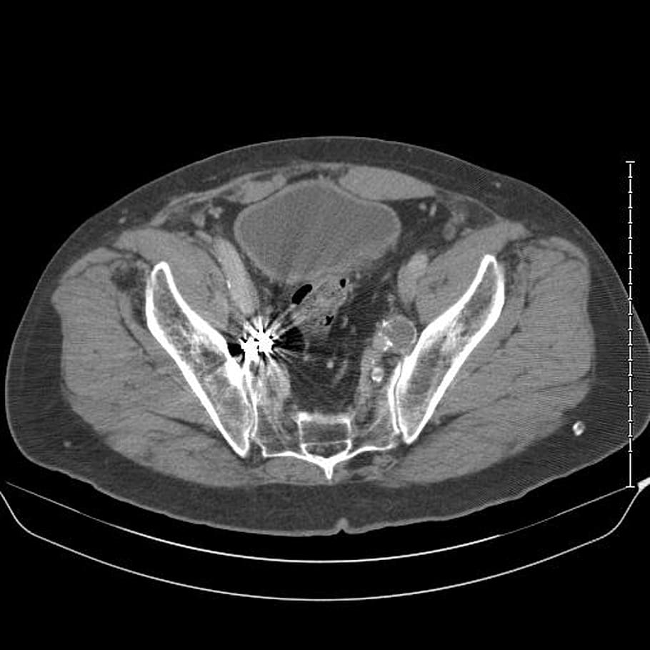 iliac, artery, branches, operation, mri, medical, catscan, xray HD wallpaper