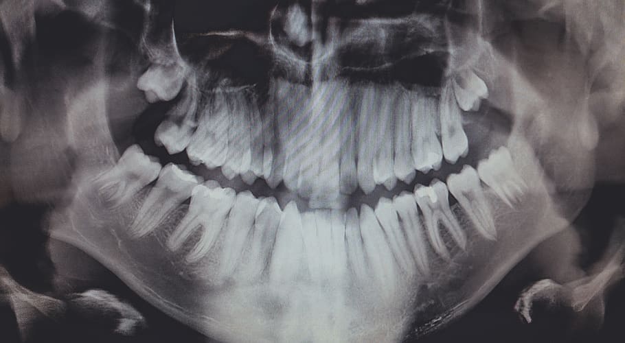 united states, poulsbo, x-ray, teeth, bones, close-up, human body part