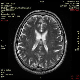 brain, scan, mri, demyelinating, medical, doctors, magnetic HD wallpaper