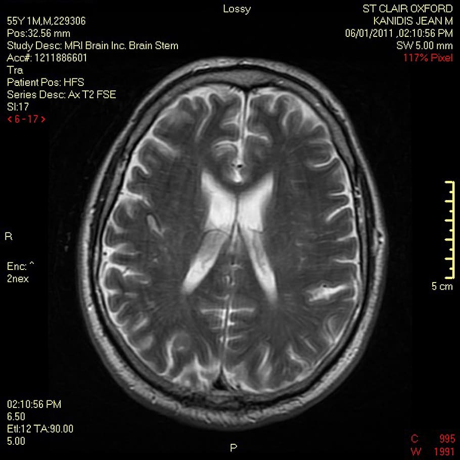 brain, scan, mri, demyelinating, medical, doctors, magnetic, HD wallpaper